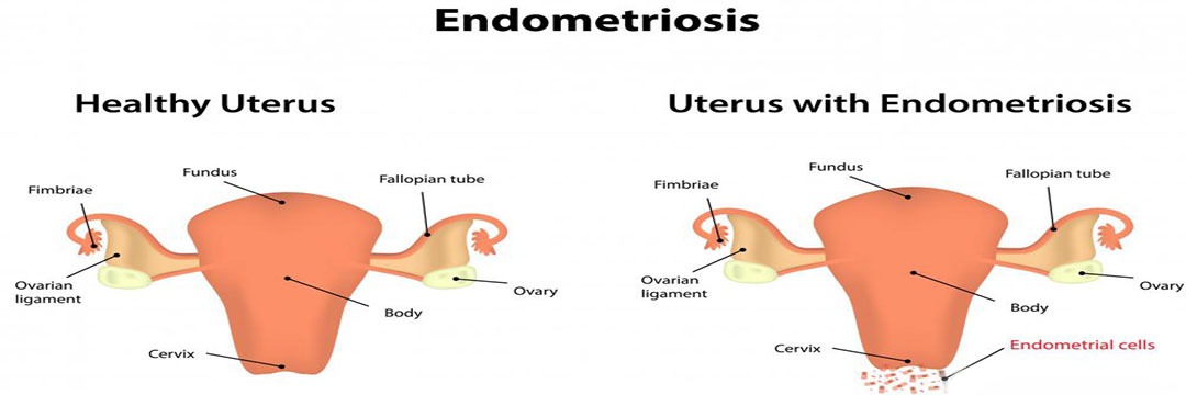 Endometriosis: What You Need To Know